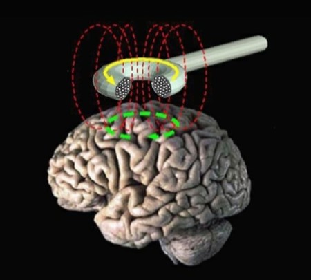 Estimulacion Transcraneal Corriente Foto Wikipedia Ediima20140628 0619 13