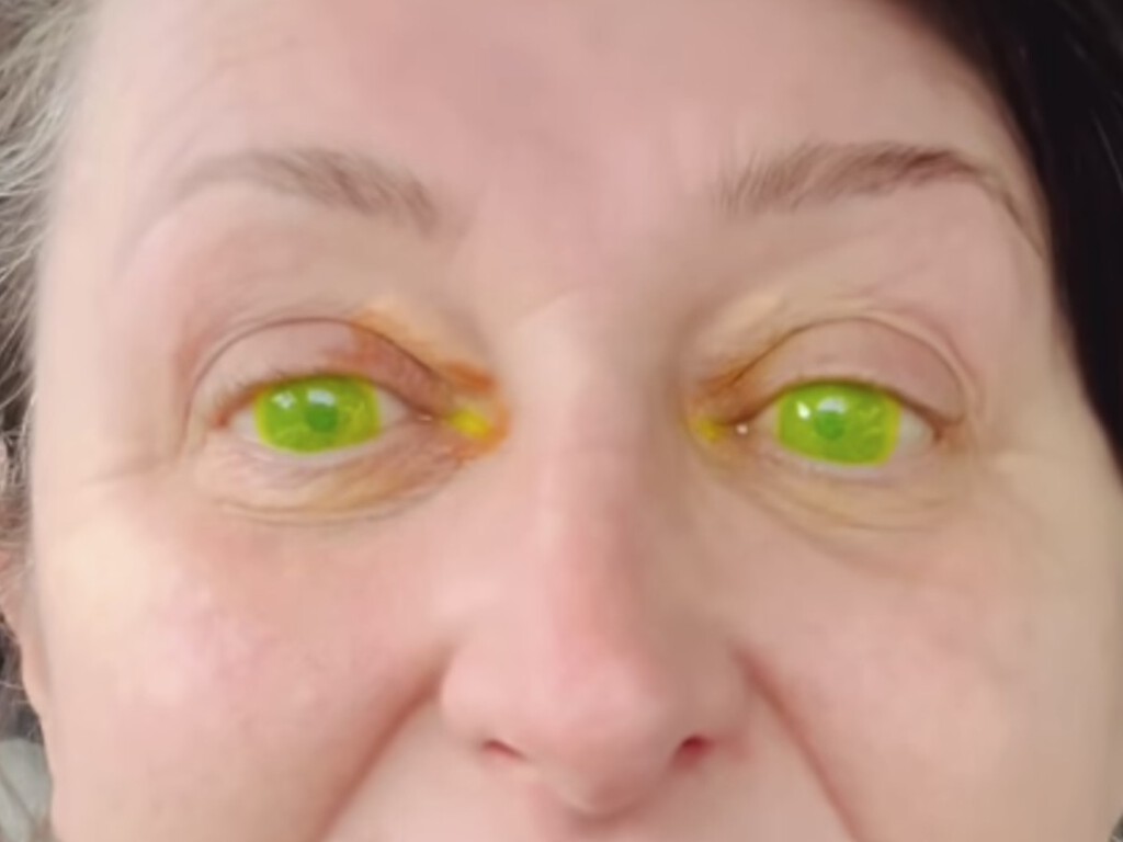 Os médicos não acreditaram no que viram: o efeito colateral assustador que fez os olhos de uma mulher brilharem no escuro