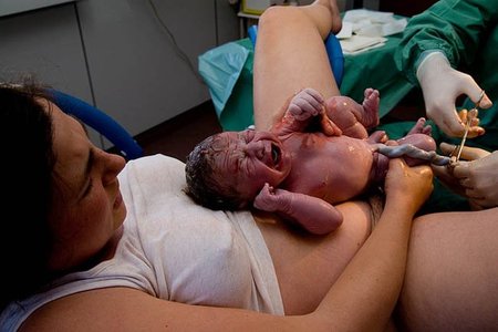 La transfusión placentaria y la posición del bebé al nacer