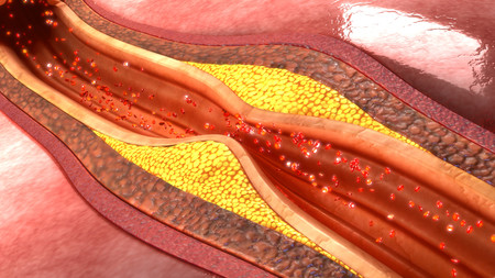 Arterioesclerosis
