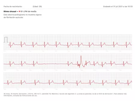 グラフ中央の 2 行目に、拍動内のブロックを示す ECG。