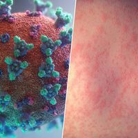 El sarampión no ha vuelto, se ha disparado: de los 300 casos en EEUU a las cifras récord de Europa en 25 años