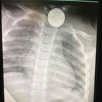 Una madre advierte sobre los peligros de las pilas de botón después de que su hija falleciera al tragarse una