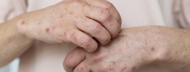 México está a punto de perder su estatus de país libre de sarampión; el virus gana terreno