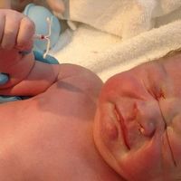 La increíble fotografia de un recién nacido sosteniendo en su mano el DIU que falló