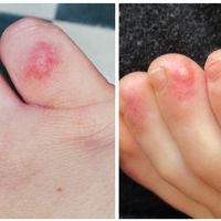 Sabañones en pies y manos, urticaria y lesiones con vesícula, otros posibles síntomas de infección por coronavirus