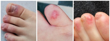 Sabañones en pies y manos, urticaria y lesiones con vesícula, otros posibles síntomas de infección por coronavirus