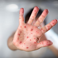 Aumentan un 300 por ciento los casos de sarampión a nivel mundial, alerta la OMS