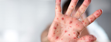 Aumentan un 300 por ciento los casos de sarampión a nivel mundial, alerta la OMS