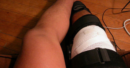 Identificado un nuevo ligamento en la rodilla