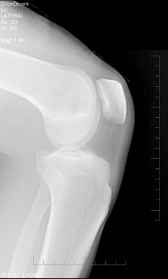 Revisión de tratamientos para la artrosis de rodilla