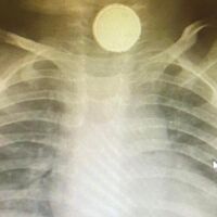 Una bebé vive con una pila de botón en su garganta durante cuatro meses y tiene graves secuelas