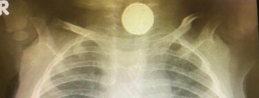 Una bebé vive con una pila de botón en su garganta durante cuatro meses y tiene graves secuelas