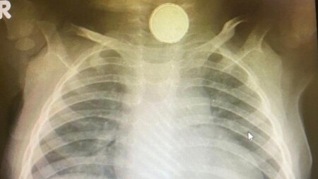 Una bebé vive con una pila de botón en su garganta durante cuatro meses y tiene graves secuelas