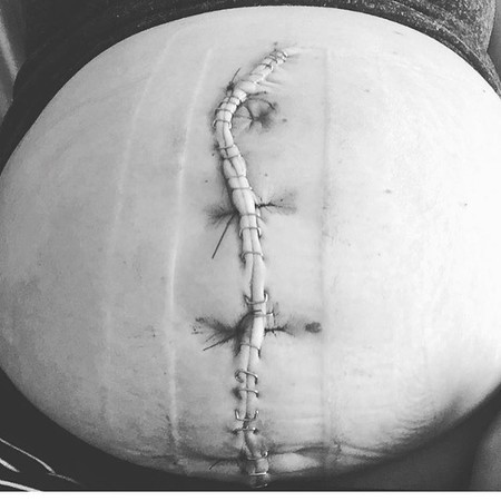 Comparte orgullosa la cicatriz vertical de su cesárea que permitió que naciera su bebé