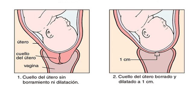 cuello uterino corto y embarazo