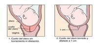¿Qué es el borramiento del cuello uterino?