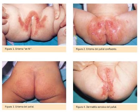 El programa vivir bien sobre la psoriasis el tratamiento