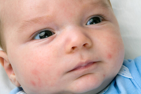 acne-neonatal