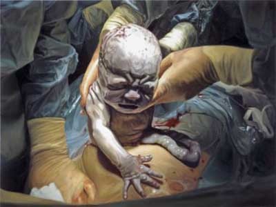 Pinturas hiperrealistas de una cesárea, por Damien Hirst