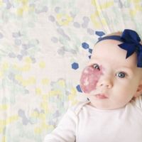 Su madre pide que vean a la preciosa bebé detrás del hemangioma