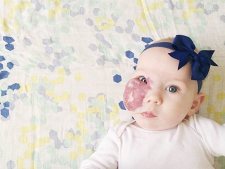 Su madre pide que vean a la preciosa bebé detrás del hemangioma
