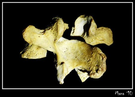 Todo sobre la columna vertebral(I): hernia discal