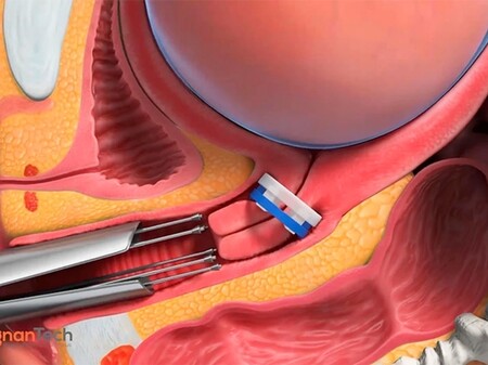 anillo-parto-prematuro