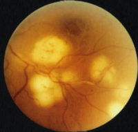 Ret-cam, fotografías oculares a niños prematuros que permiten luchar contra la ceguera 