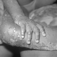 Viruela del mono: síntomas y cómo se contagia esta rara enfermedad que puede afectar a niños y embarazadas