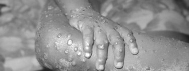 Viruela del mono: síntomas y cómo se contagia esta rara enfermedad que puede afectar a niños y embarazadas