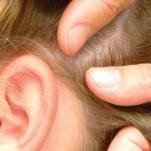 Piojos más resistentes contra la población infantil