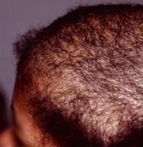 Tricotilomanía, arrancarse el pelo de forma compulsiva