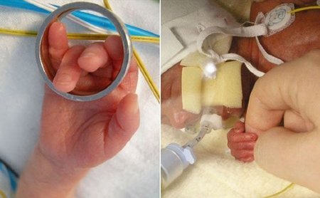Nacen gemelos prematuros de 26 semanas de gestación