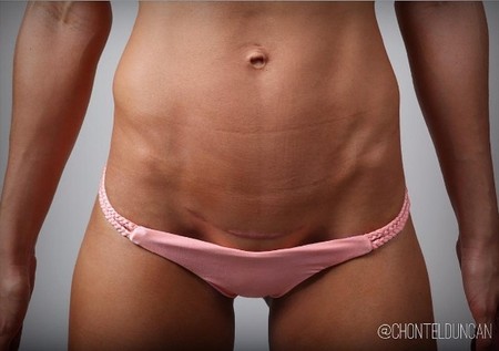 Cesarea por despues del barriga parto