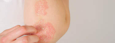 Psoriasis: qué es y qué hacer cuando tenemos un brote