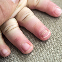 Principales problemas y alteraciones en las uñas de los niños