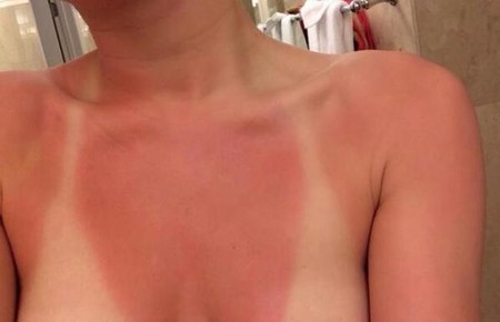 Adivina a quién... se le ha olvidado ponerse crema solar para ir a la playa