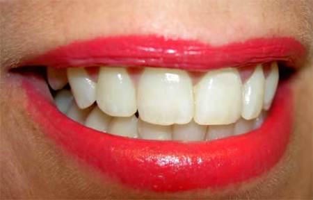 Motivos insospechados de caries