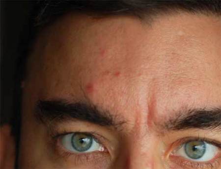 Acné, conocerlo para ponerle remedio
