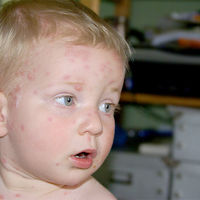 La Varicela en niños: todo lo que hay que saber