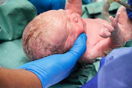 Le hacen una cesárea sin anestesia para salvar la vida de su hijo