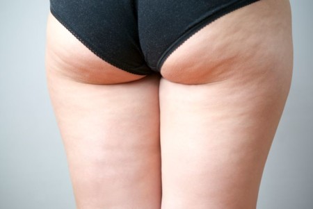 Combate la celulitis SIN MILAGROS