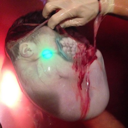 Una increíble foto muestra cómo están los bebés en el útero al nacer con la bolsa intacta