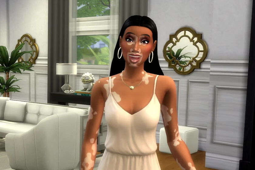 Sims 4 Vitiligo
