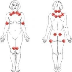 La fibromialgia.