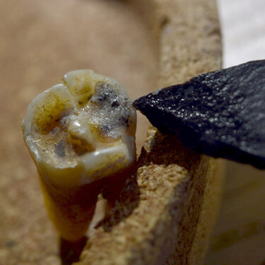 El primer dentista de la historia fue un neandertal: hace 60.000 años se atrevió a eliminar una caries