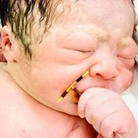 La foto viral del bebé recién nacido agarrado al DIU que tenía implantado su madre