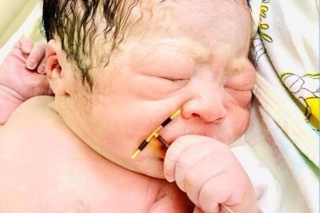 La foto viral del bebé recién nacido agarrado al DIU que tenía implantado su madre