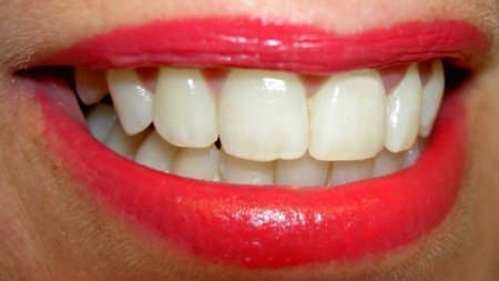 Los adultos también podemos tener caries